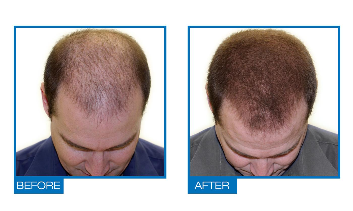 Omiera Labs Exalt Advanced Natural Hair Growth Serum - image 2
