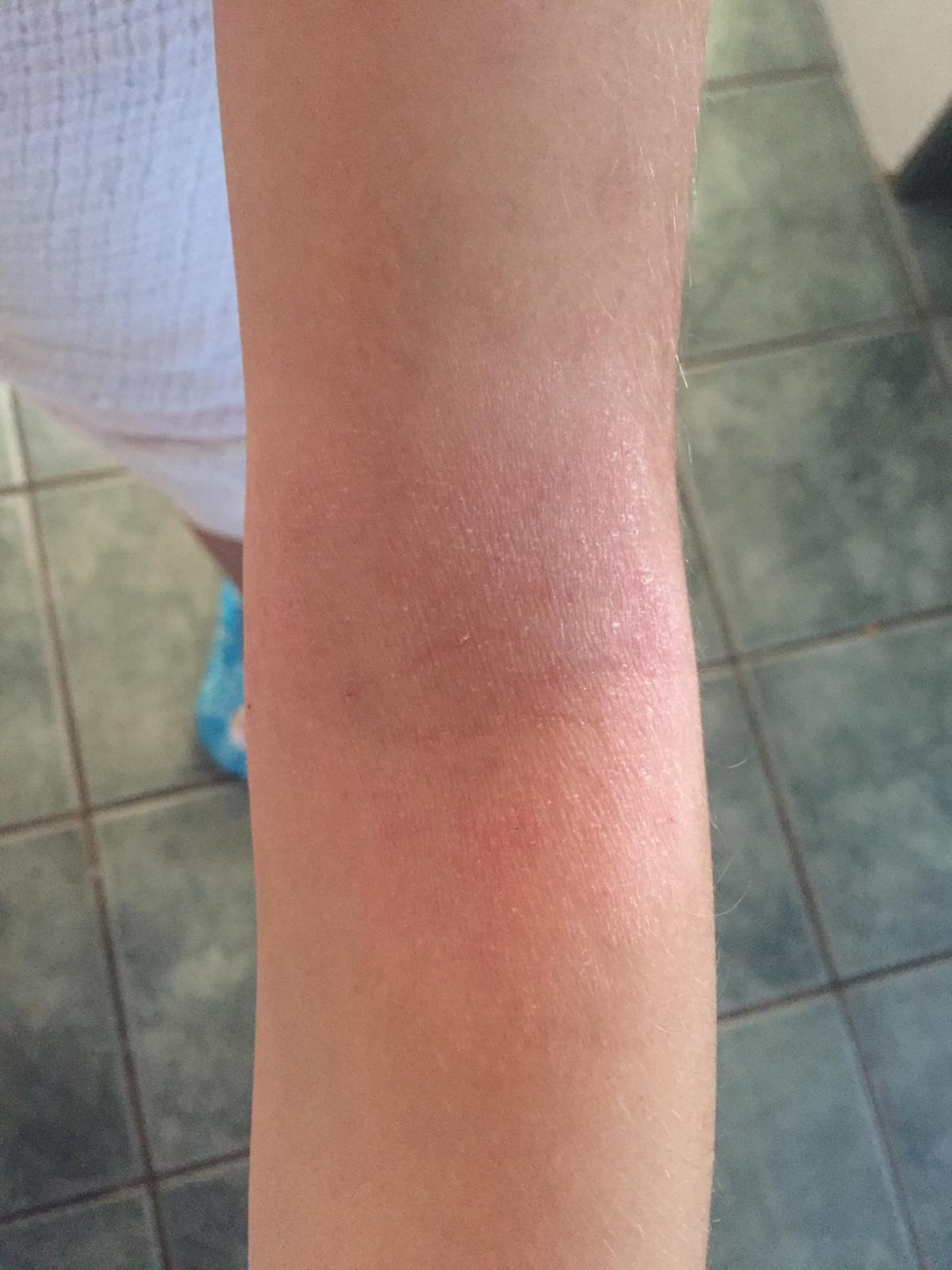 Indigo Calm Balm: Eczema, Rosacea, Inflammation, Psoriasis and Dermatitis - image 3