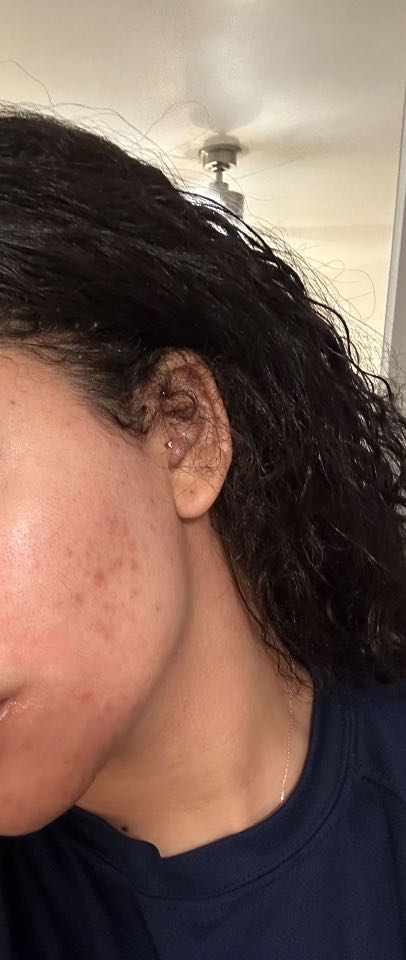 The Spot Peel review photo by Jordan C.