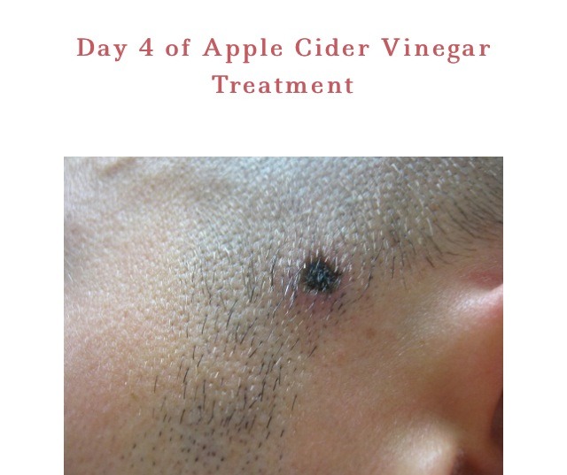 " How To Remove A Mole With Apple Cider Vinegar" Musely