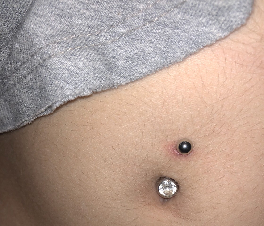 Is My Belly Button Piercing Infected By Pattie P Musely