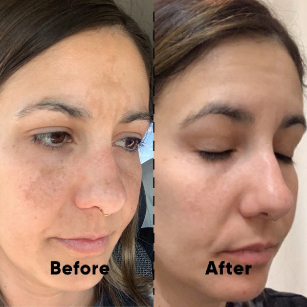 Dark Spot Corrector/Removers Hydroquinone, Tranexamic Acid, And Azelaic Acid Cream For Face