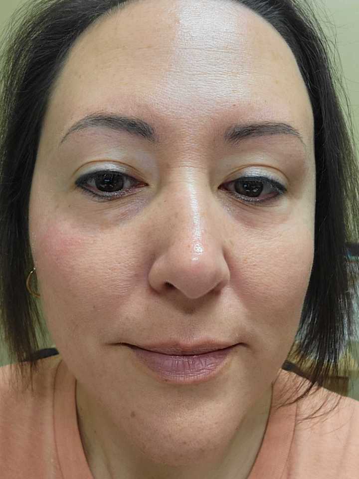 The Spot Peel review photo by Holly B.