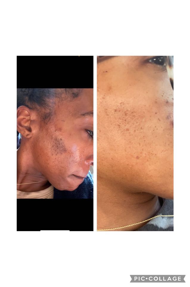 The Spot Peel review photo by Blake H.