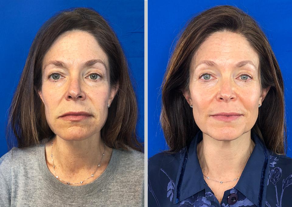Mimi B, 54
After just 2 months of use