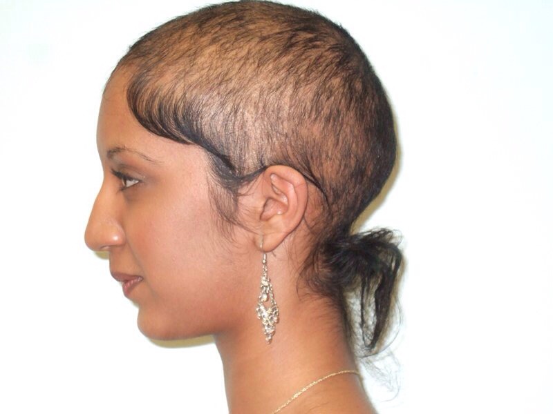 Hair Loss Treatment By Kary Garcia Musely