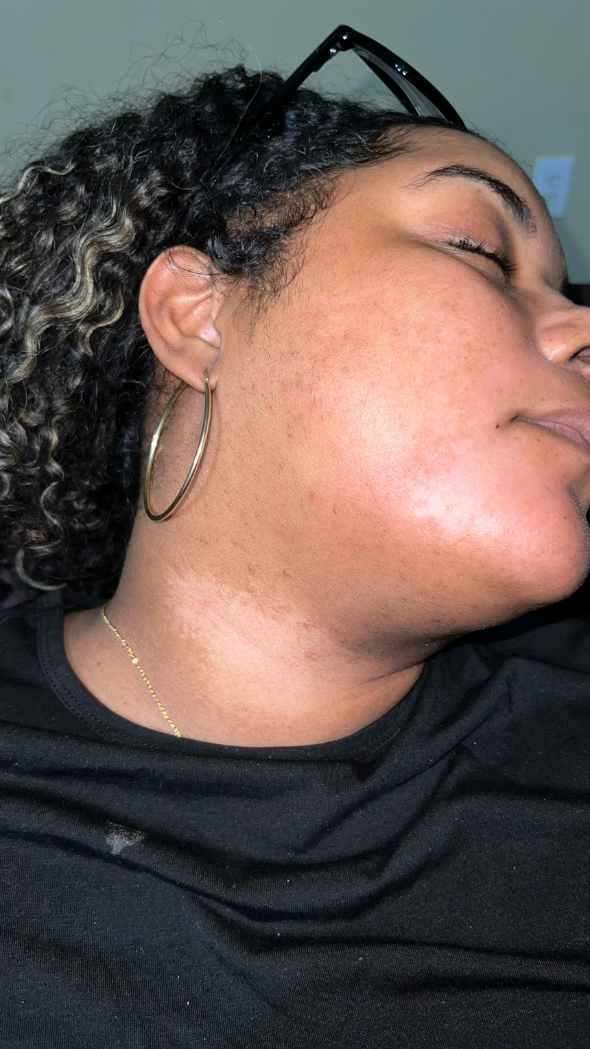 The Spot Peel review photo by Yauna F.