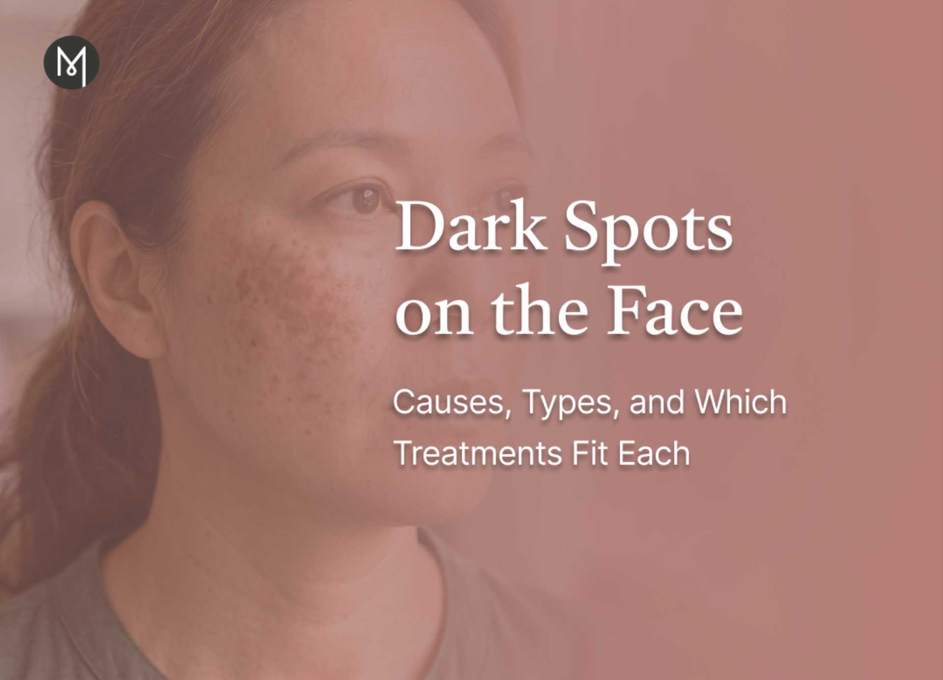 Dark Spots on the Face: Causes, Types, and Which Treatments Fit Each