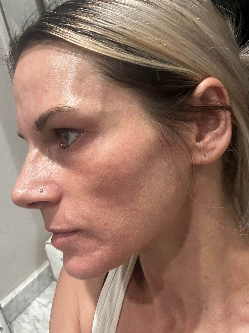 The Spot Peel review photo by Nicole C.