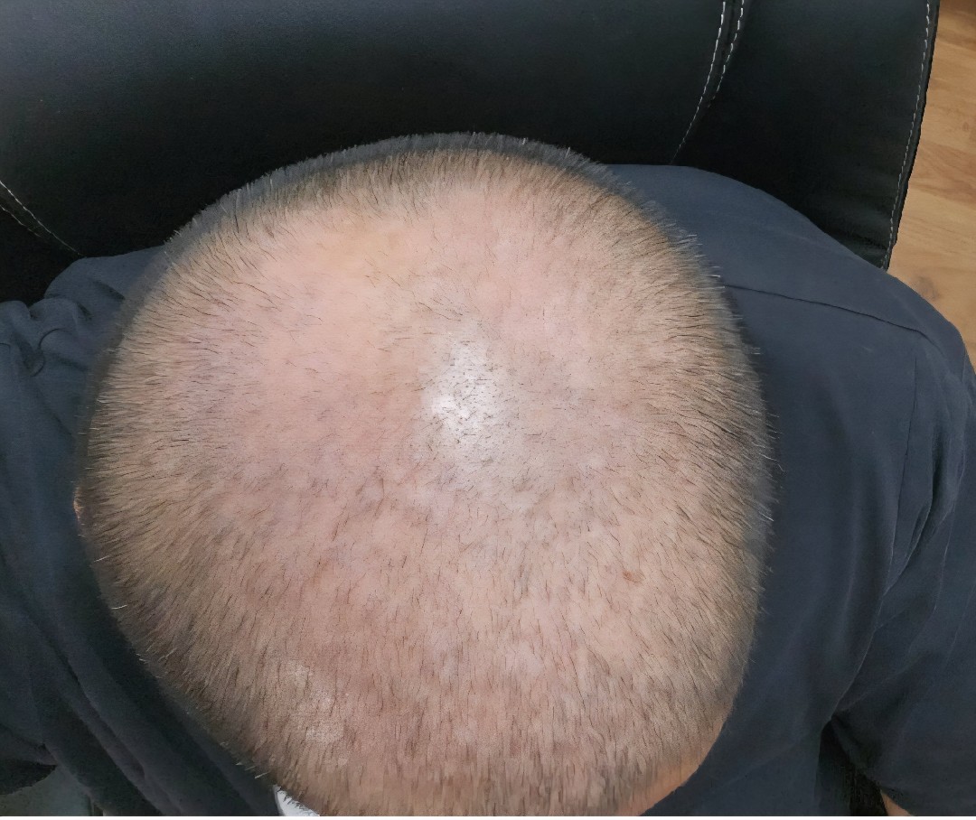 The Hair Topical Solution - Modern review photo by Patient M.