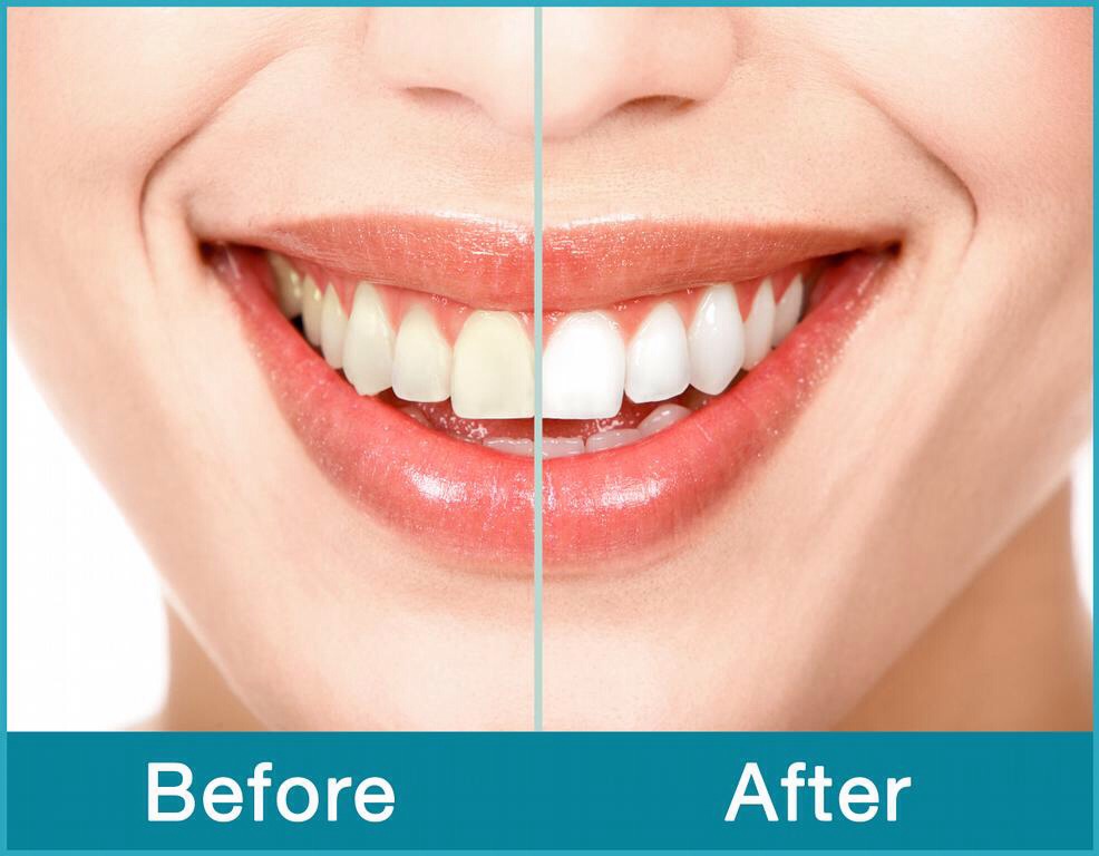 Perfect White Teeth SAFELY! Like And Save Please! Musely