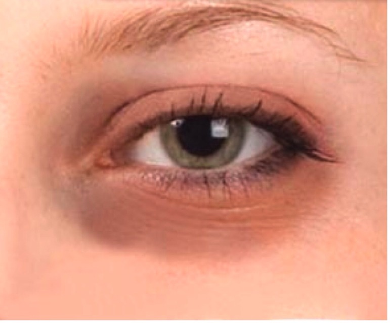 Natural Remedy Dark Circles Puffy Eyes Natural Remedy Dark Circles Puffy Eyes