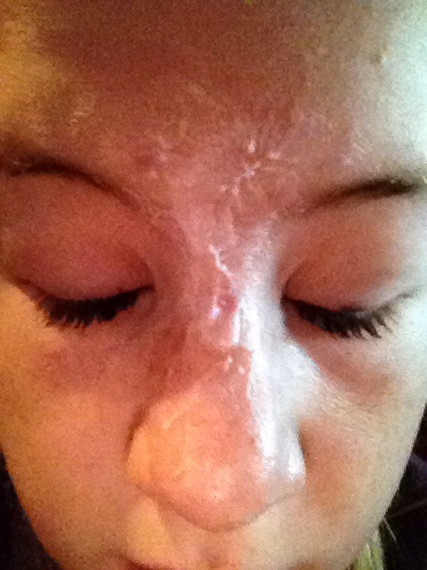 antiseptic cream for spots