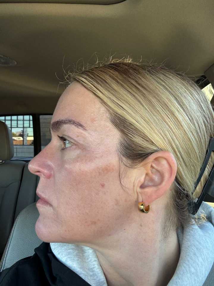The Spot Peel review photo by SKPD D.