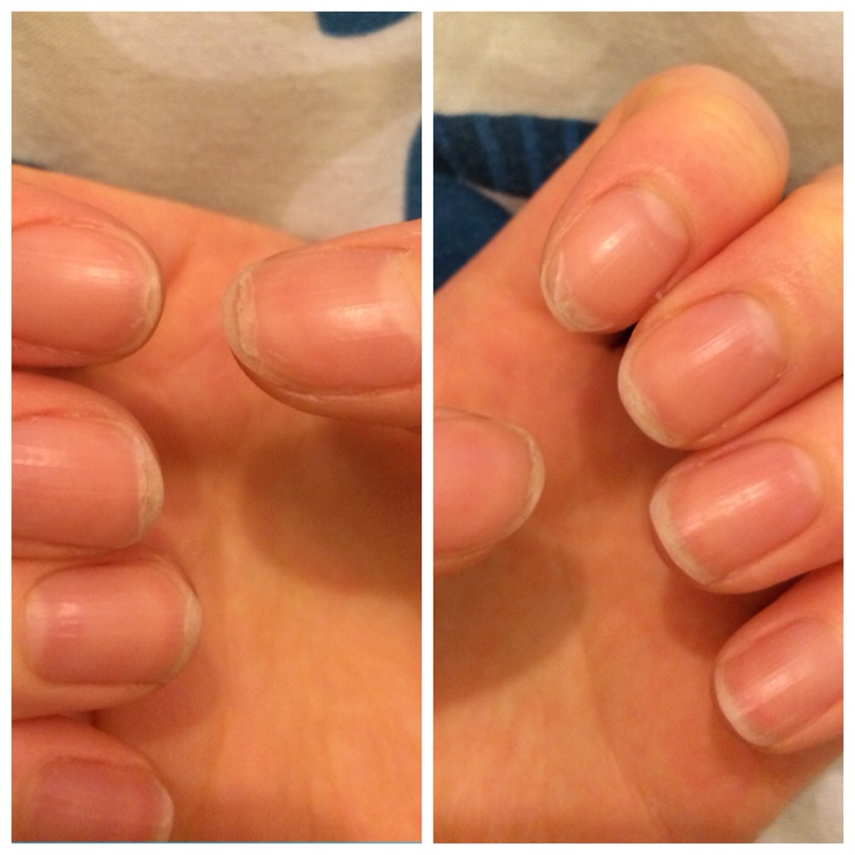 How To Fix Peeling Nails Musely