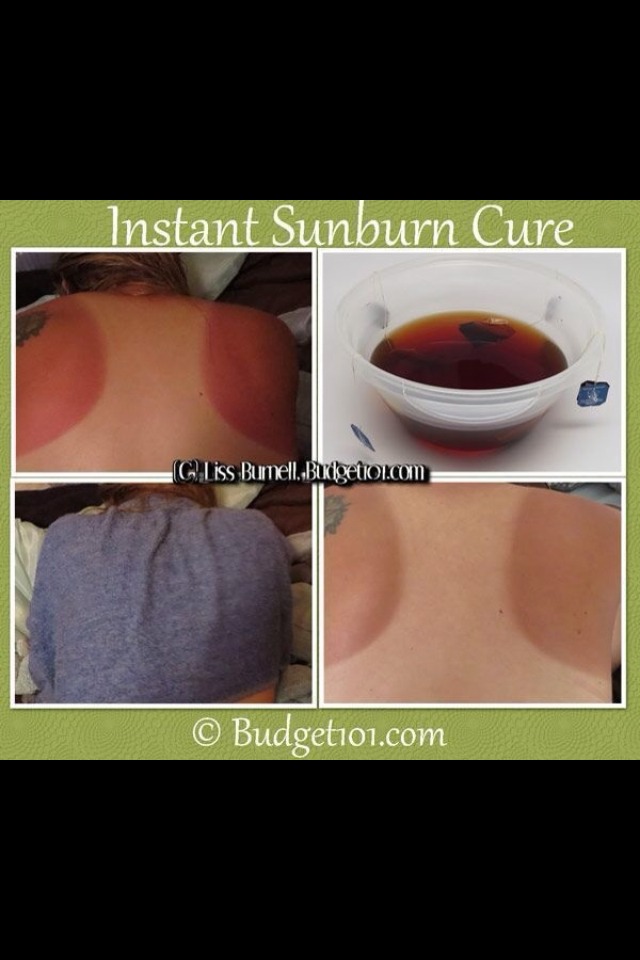 What You Should Do When You Get Sunburn And Some Natural Ways To Get