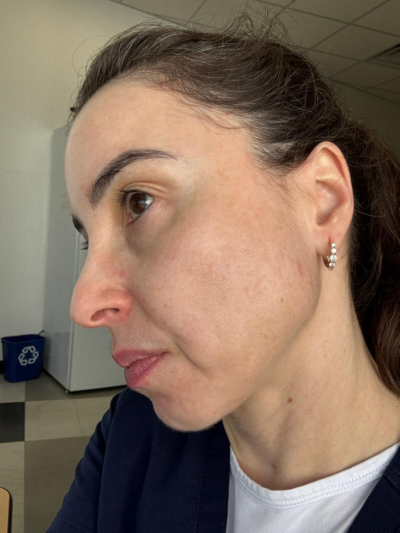 The Spot Peel review photo by Keli M.