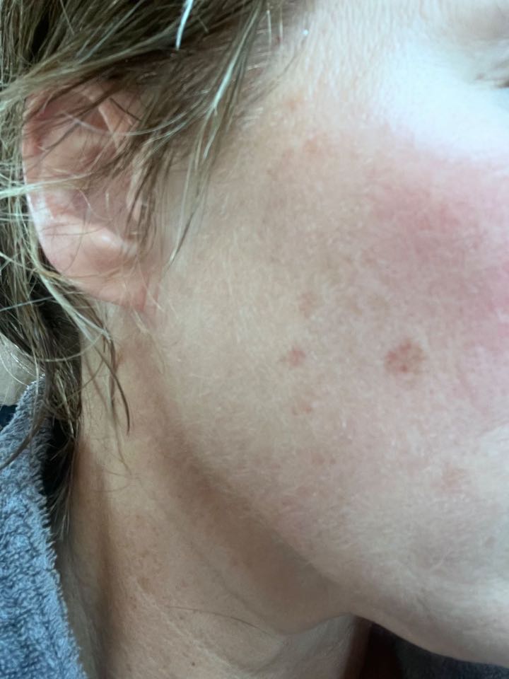 The Spot Peel review photo by Christine W.