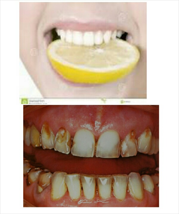 dont use lemon for teeth whiteing yes it works but it also kills the