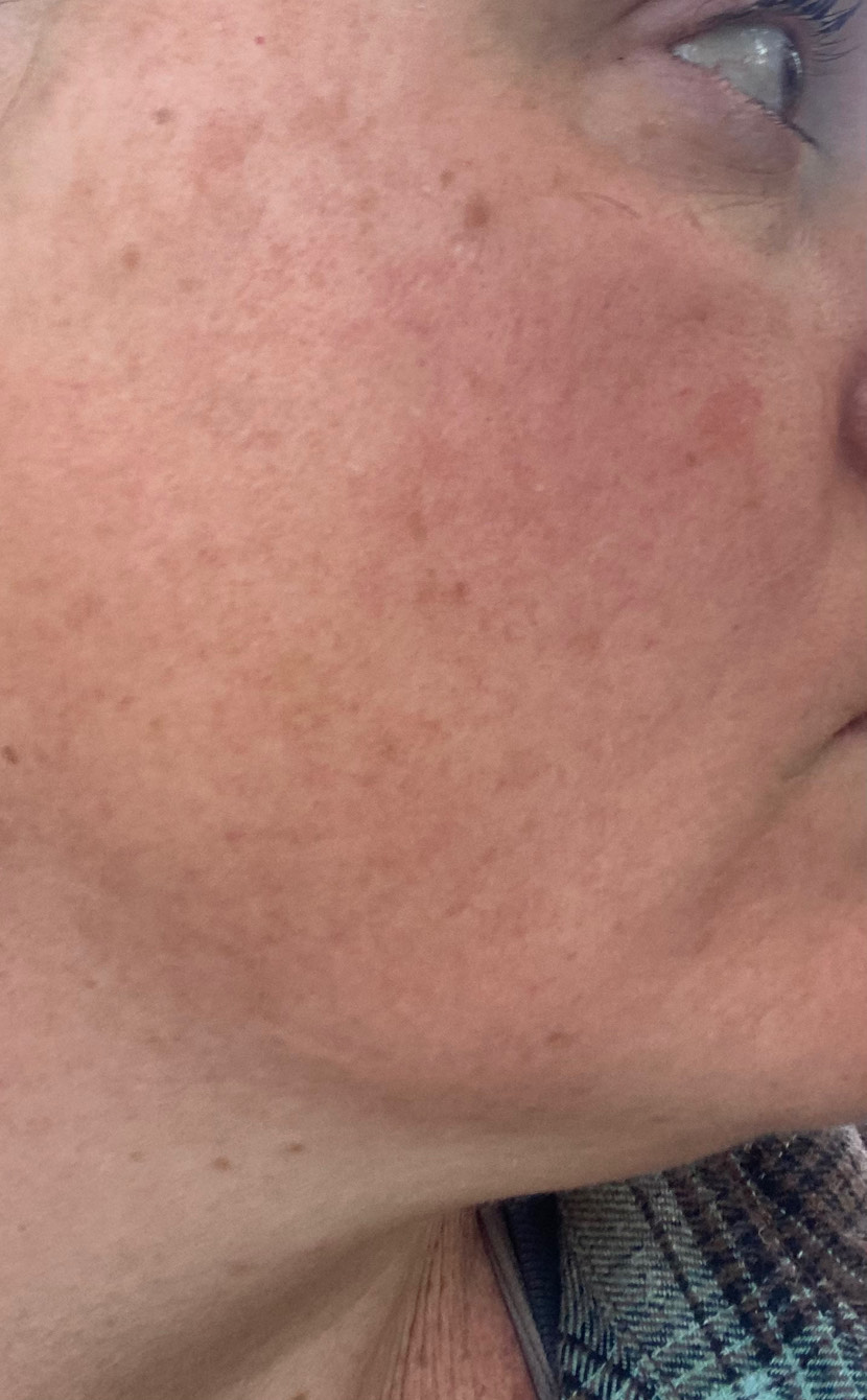 The Spot Peel review photo by Melissa G.