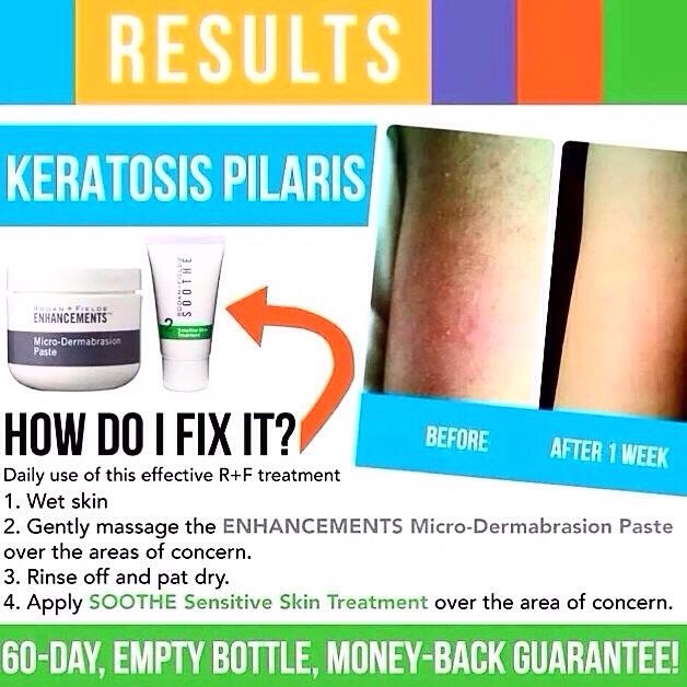 keratosis-pilaris-treatment-for-kids-kids-matttroy