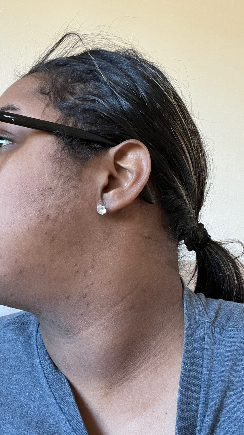 The Spot Peel review photo by Yauna F.