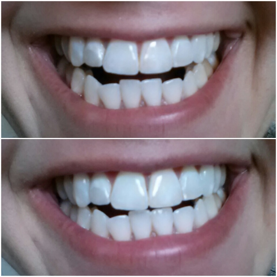 Oral Oil Pulling! Whitens Teeth And Pulls Toxins! Musely