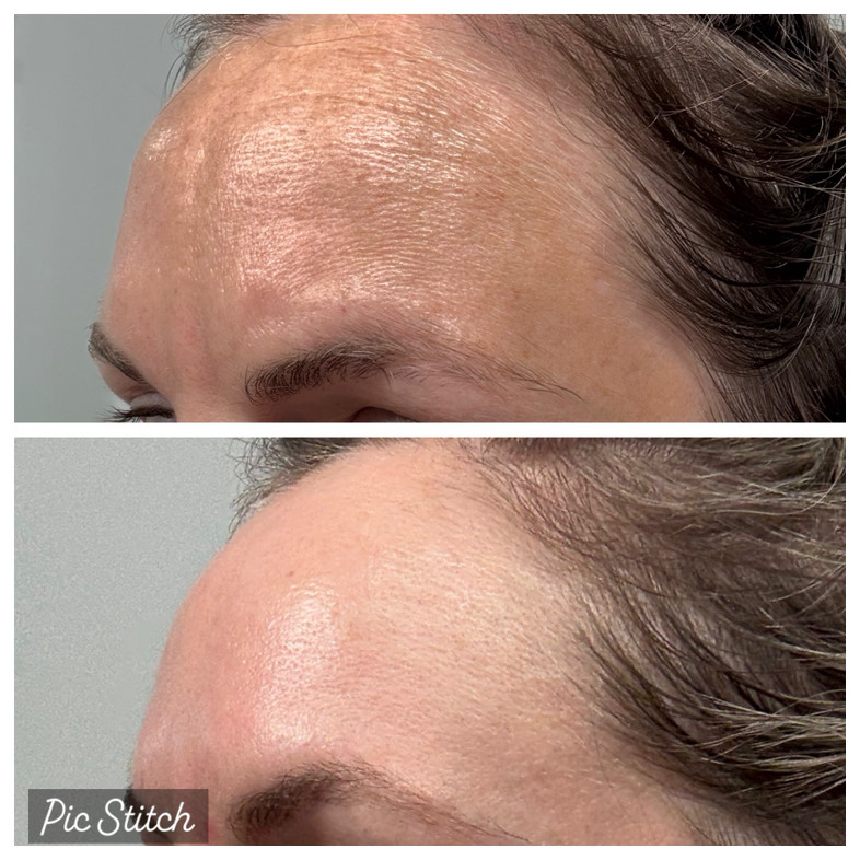 The Spot Peel review photo by Emily B.