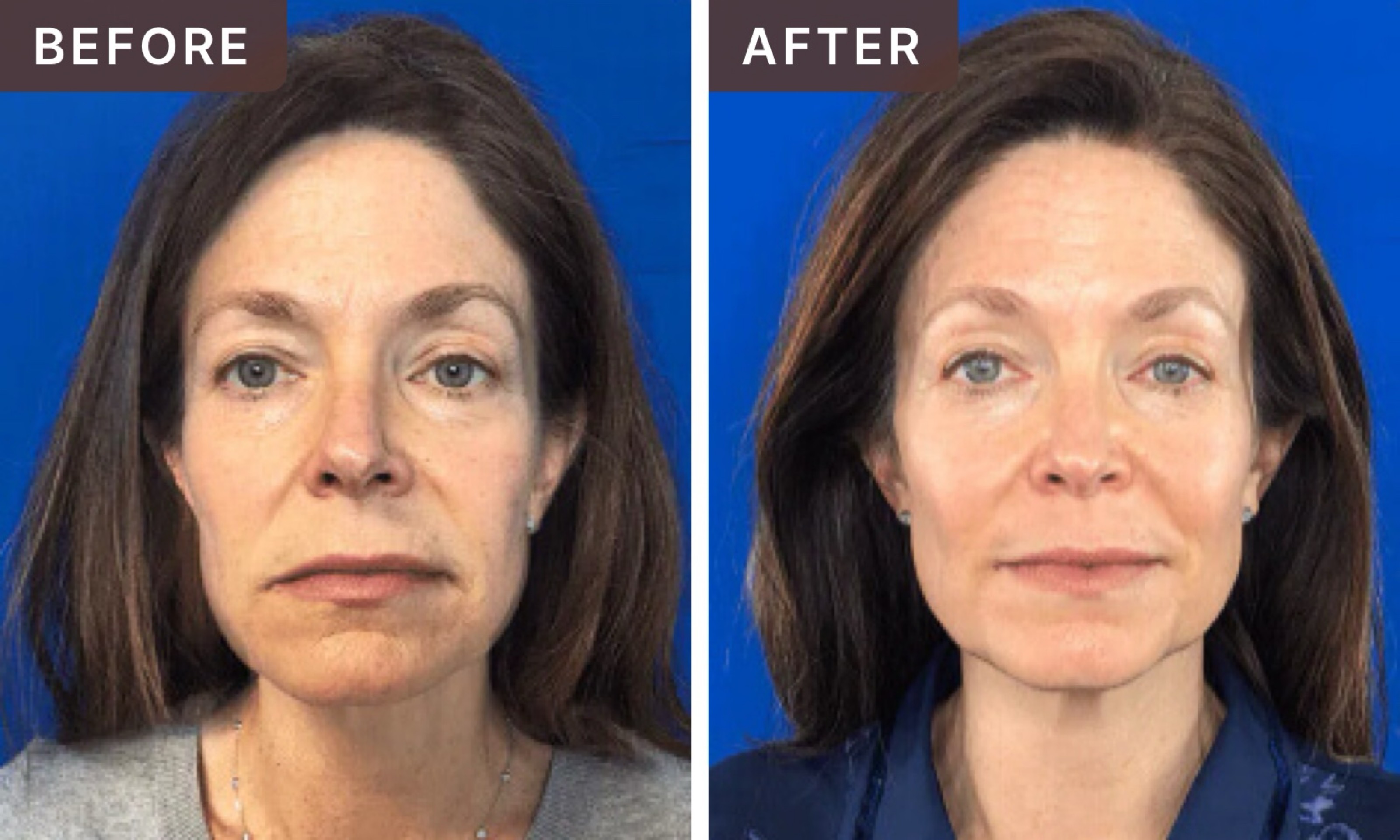 F01 T. -- before and after, 8 weeks