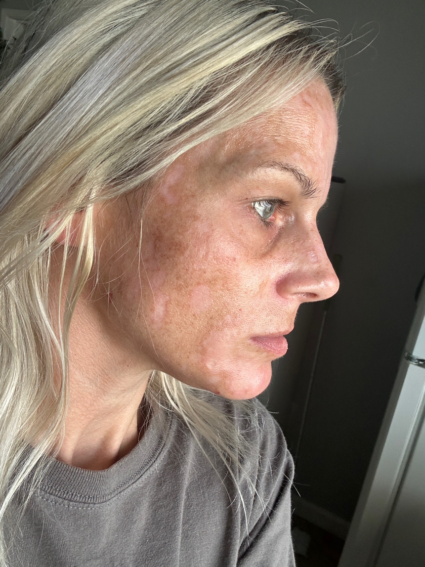The Spot Peel review photo by Nicole C.