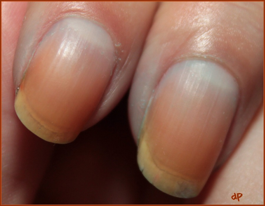 How To Stop Yellow Stains On Nails Musely