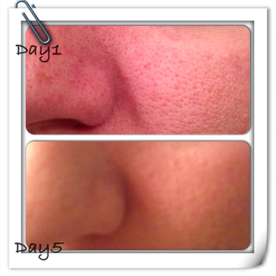 reduce-facial-pore-size-can-you-get-stds-from-oral-sex