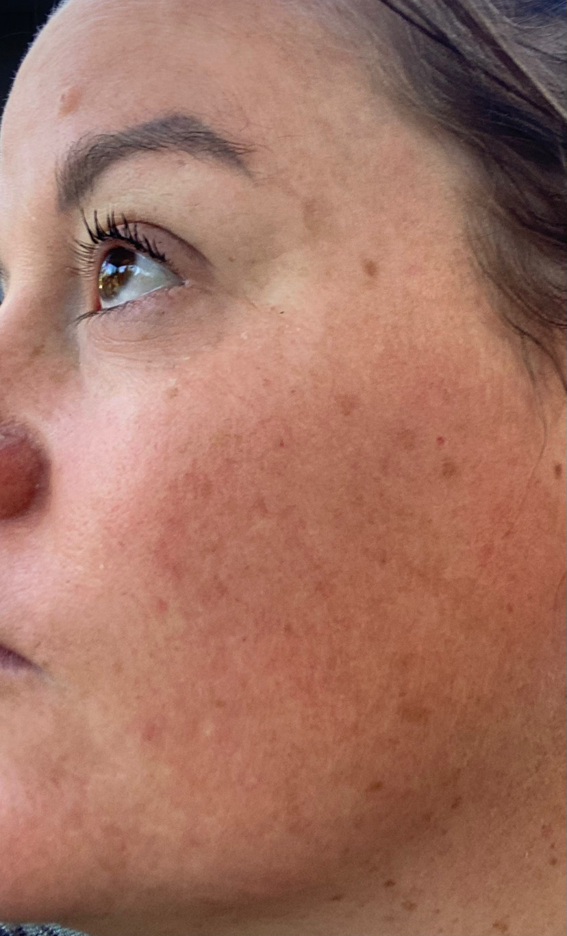 The Spot Peel review photo by Melissa G.