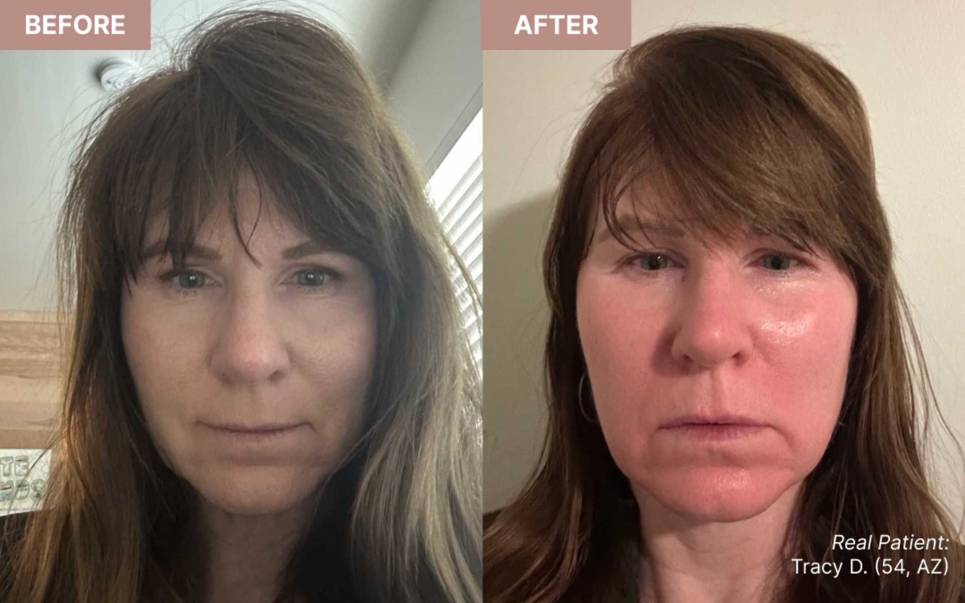 "This product is a wonderful compliment to my skin post-exfoliation/at home microneedling!"– Tracy D. (54, AZ)