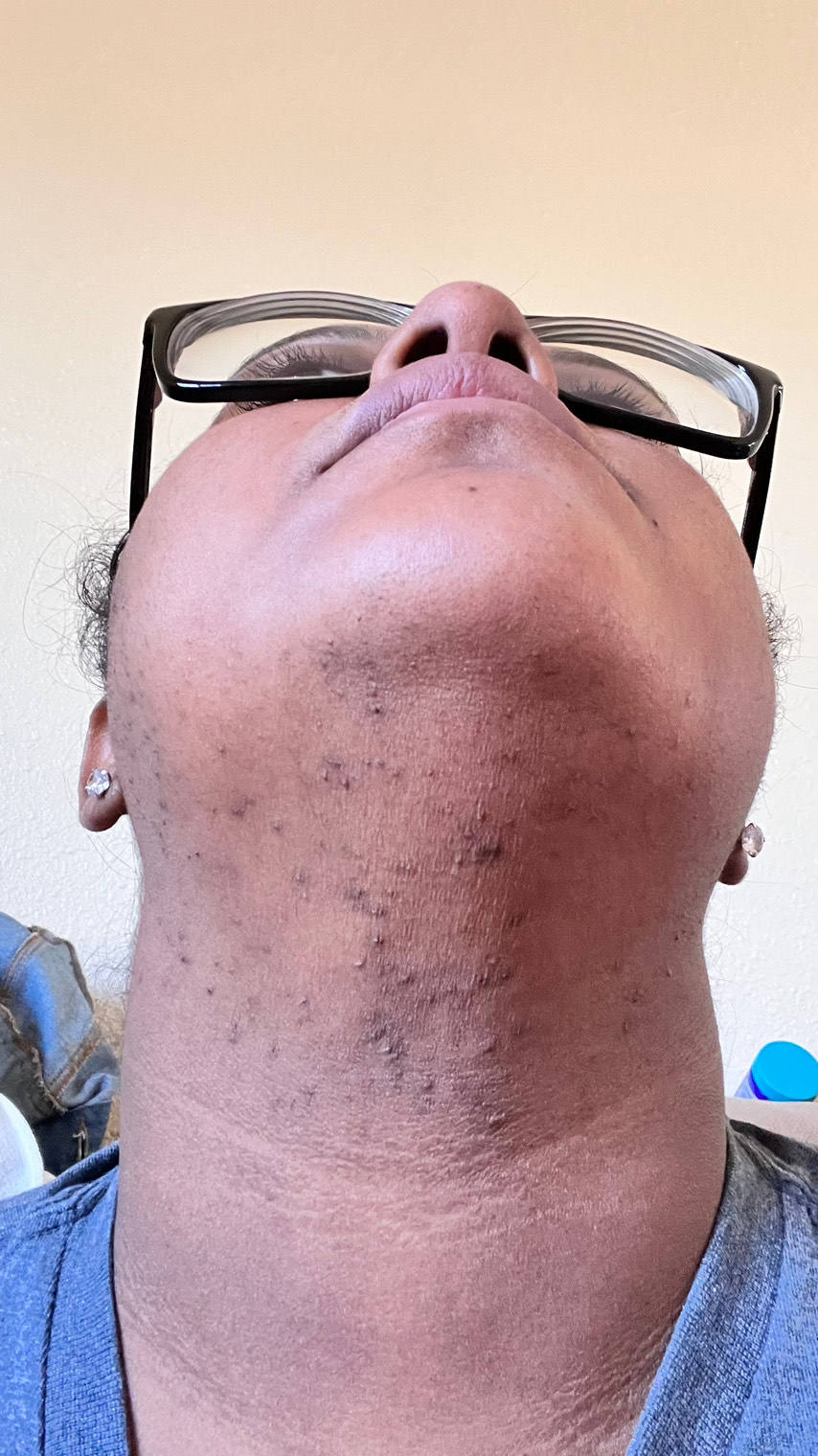 The Spot Peel review photo by Yauna F.