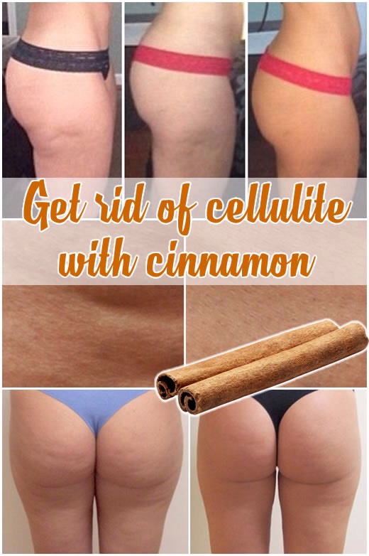 How To Get Rid Of Cellulite Using Cinnamon By Nunita Nice Musely