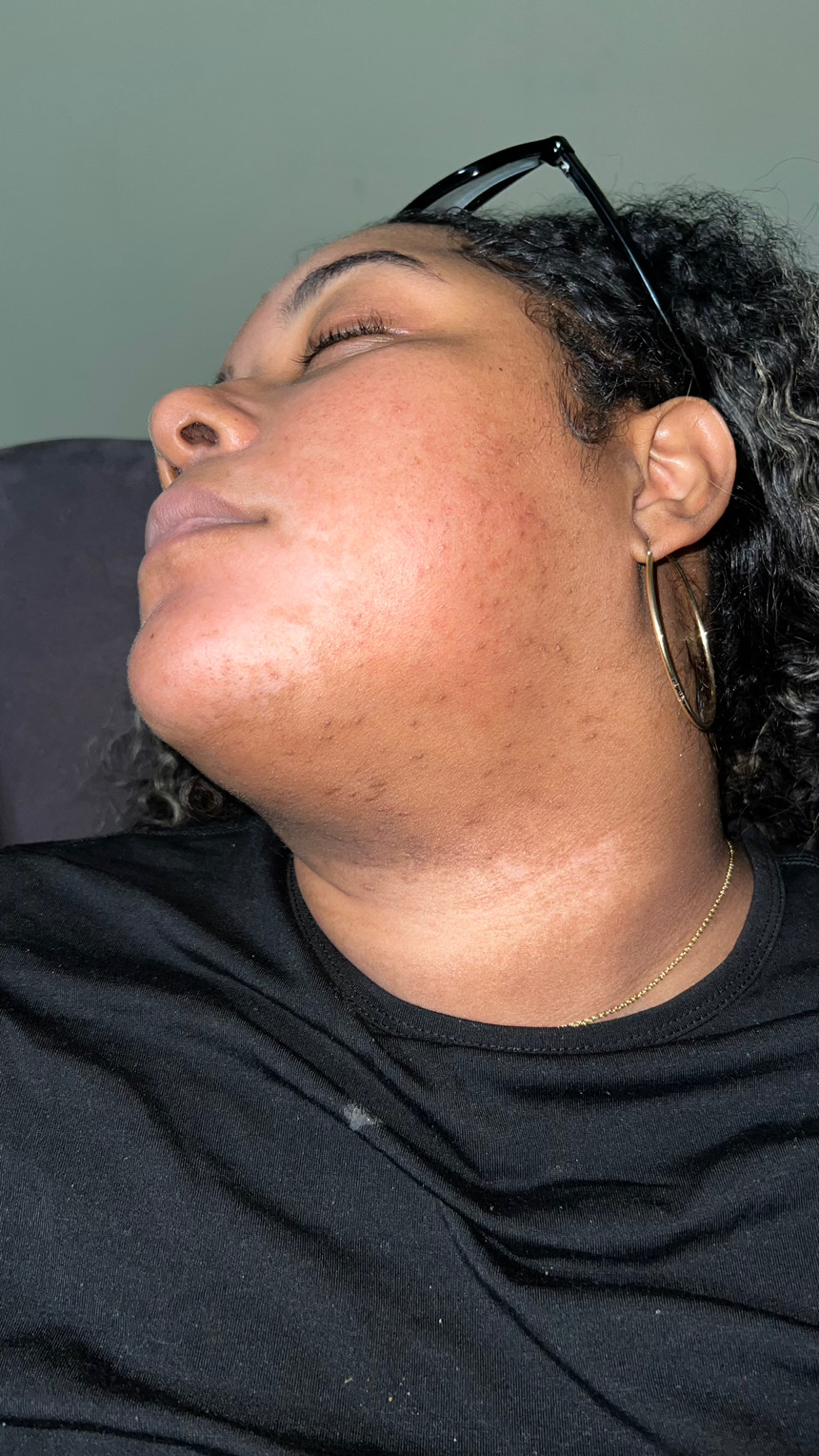 The Spot Peel review photo by Yauna F.