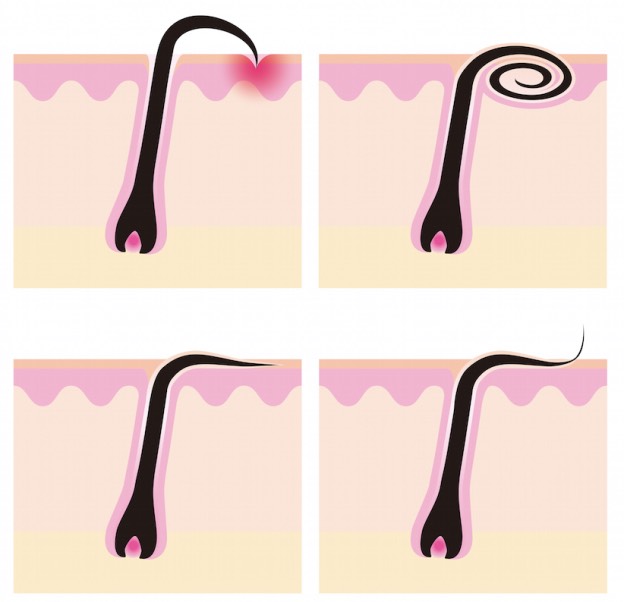 How To Remove Ingrown Hairs By Nunita Nice Musely