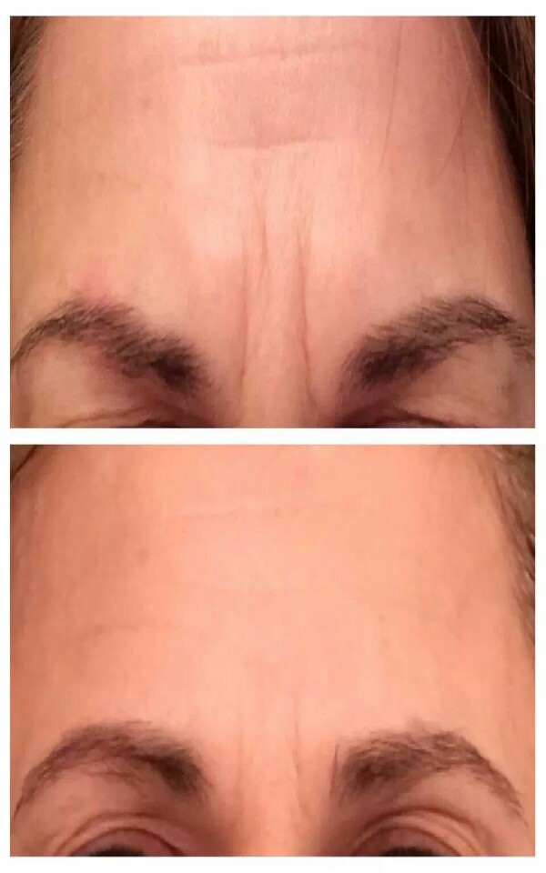 Get Rid Of Those Angry Lines One Step Product Amazing Musely