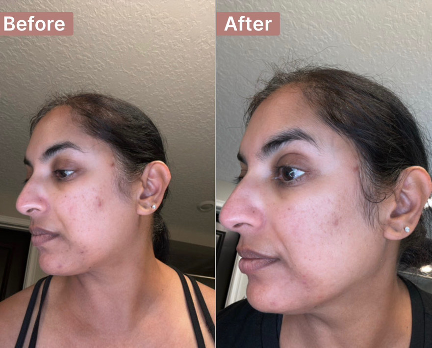 The Spot Peel review photo by Priti P.