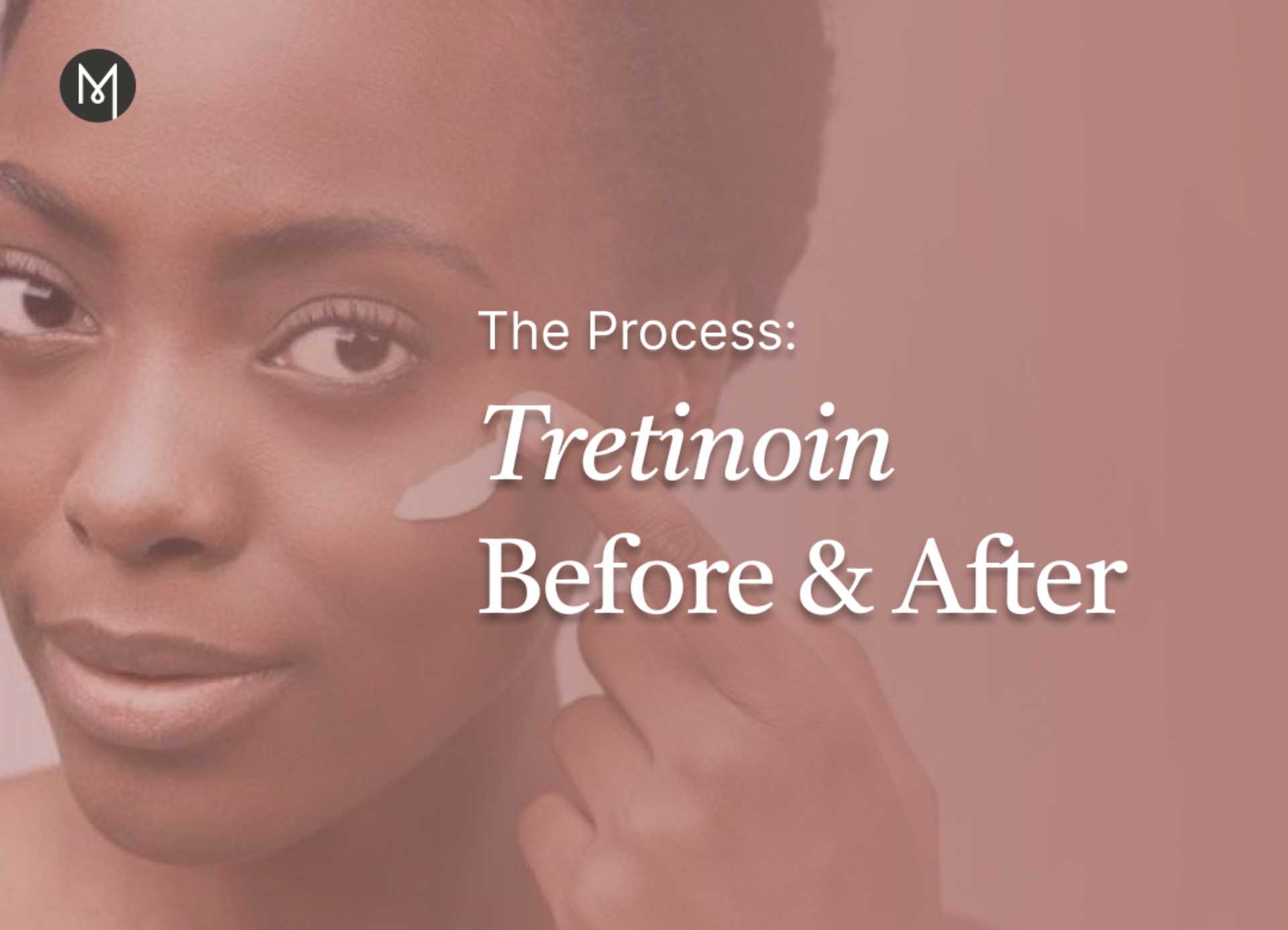 The Process: Tretinoin Before And After