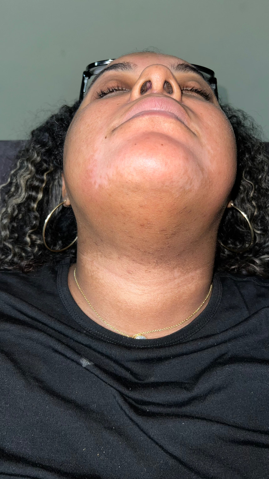 The Spot Peel review photo by Yauna F.