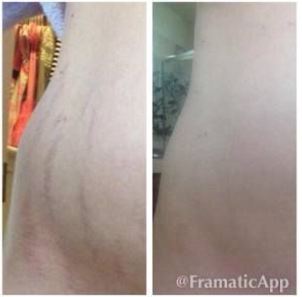 nerium stretch mark cream