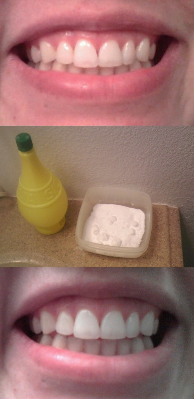 Easy DIY Teeth Whitening Musely