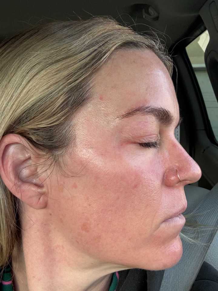 The Spot Peel review photo by SKPD D.
