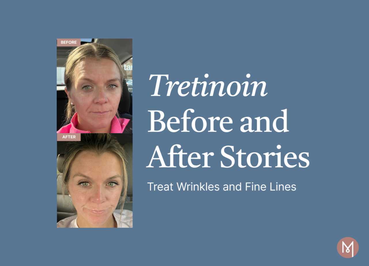 Tretinoin Before and After Stories: Treat Wrinkles and Fine Lines