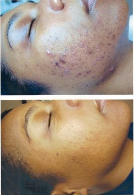How To Lighten Pigmentation On Face Naturally How To Lighten Pigmentation On Face Naturally