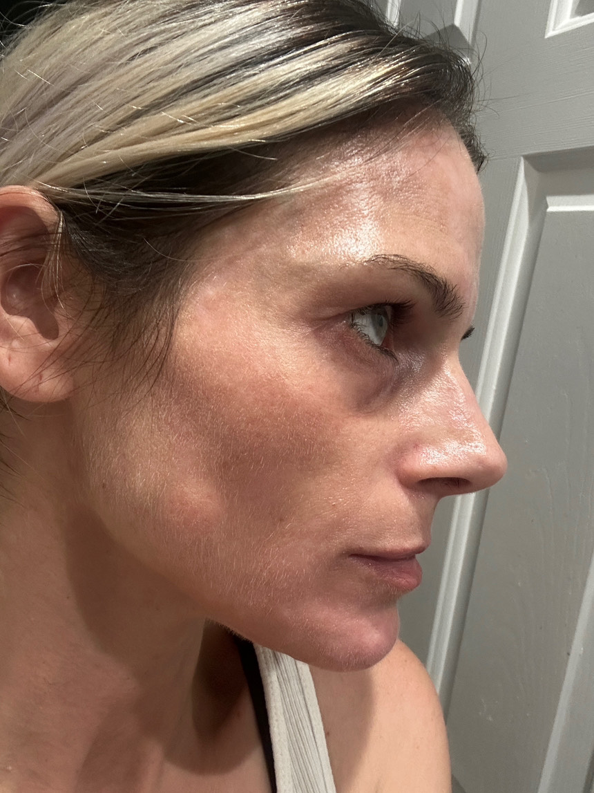 The Spot Peel review photo by Nicole C.