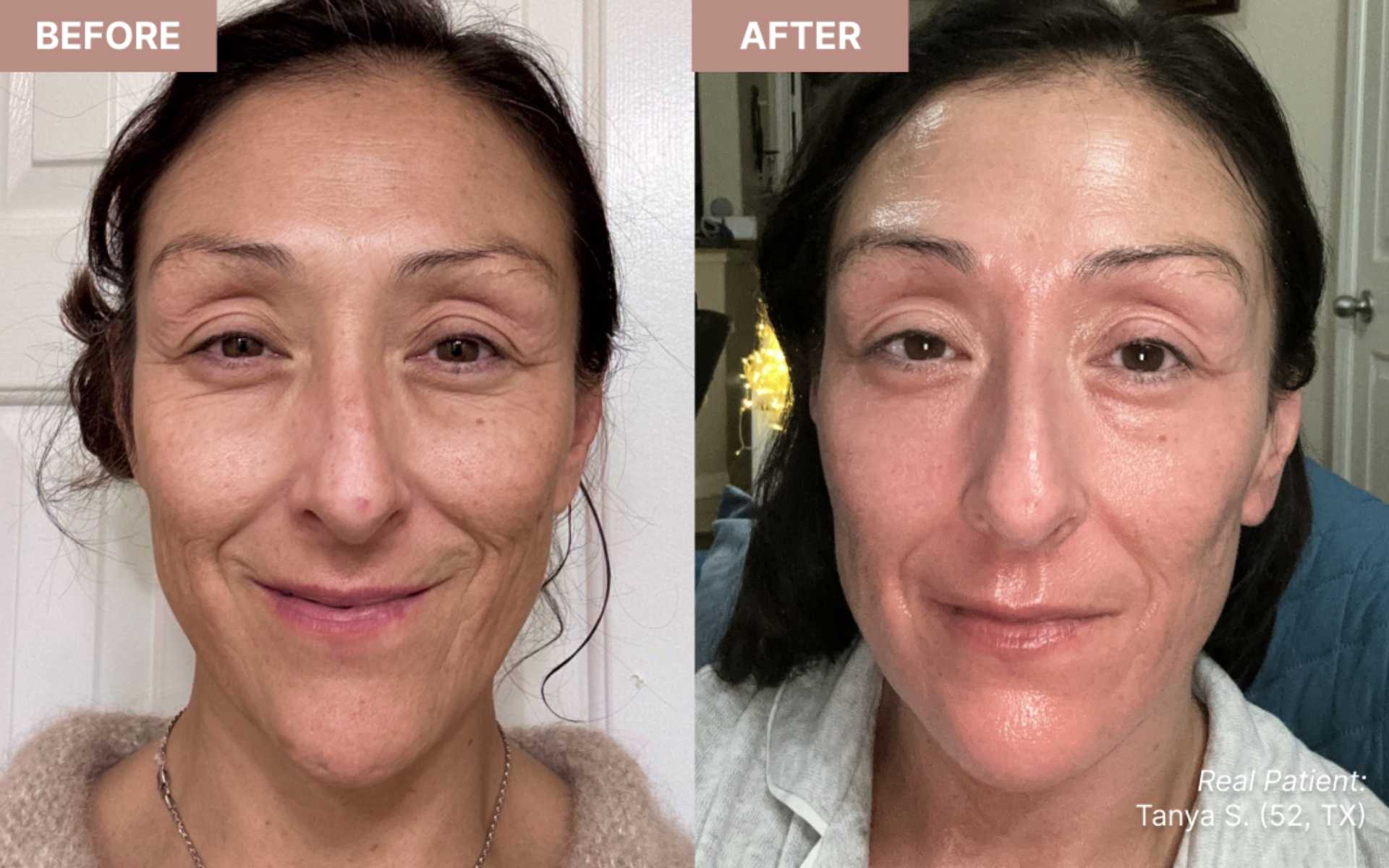 "This is the holy Grail of the future of beauty. Absolutely nothing else came close to removing the citrus fruit-like texture on my chin. This product brought me back to my perfect skin 10 years ago. Love this product and hope you make one larger for the arms and legs."– Tanya S. (52, TX)