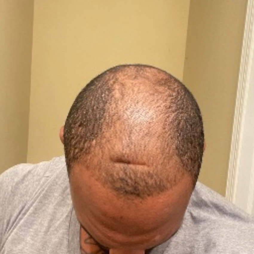 The Hair Topical Solution - Classic review photo by Kedrick H.